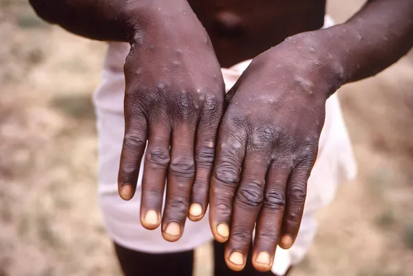 W.H.O Declares Mpox a Global Health Emergency: Critical Facts You Need to Know 2 | Mania Africa | maniainc.com Among the most notable symptoms of Mpox are lesions that appear on the skin | Mpox Symptoms, Diagnosis, & Prognosis: Critical Facts You Need to Know | Mania Health
